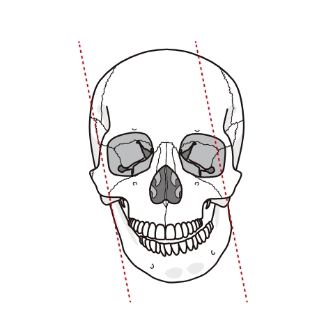 頭蓋骨の歪み