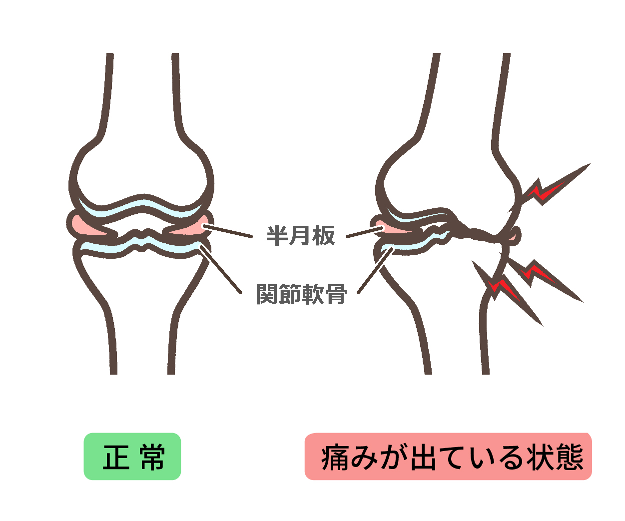 膝の変形 