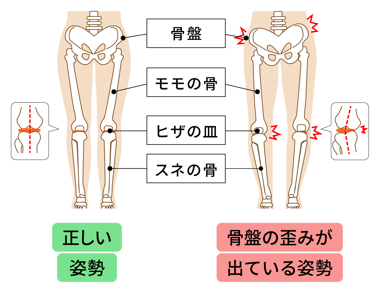 骨格や骨盤の歪み 