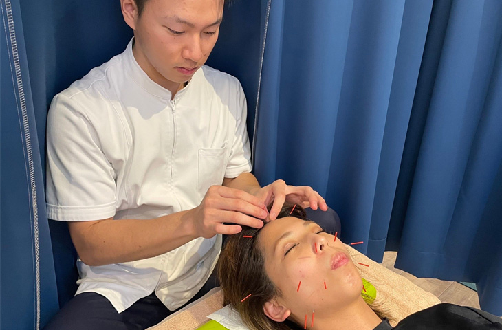美容鍼施術風景