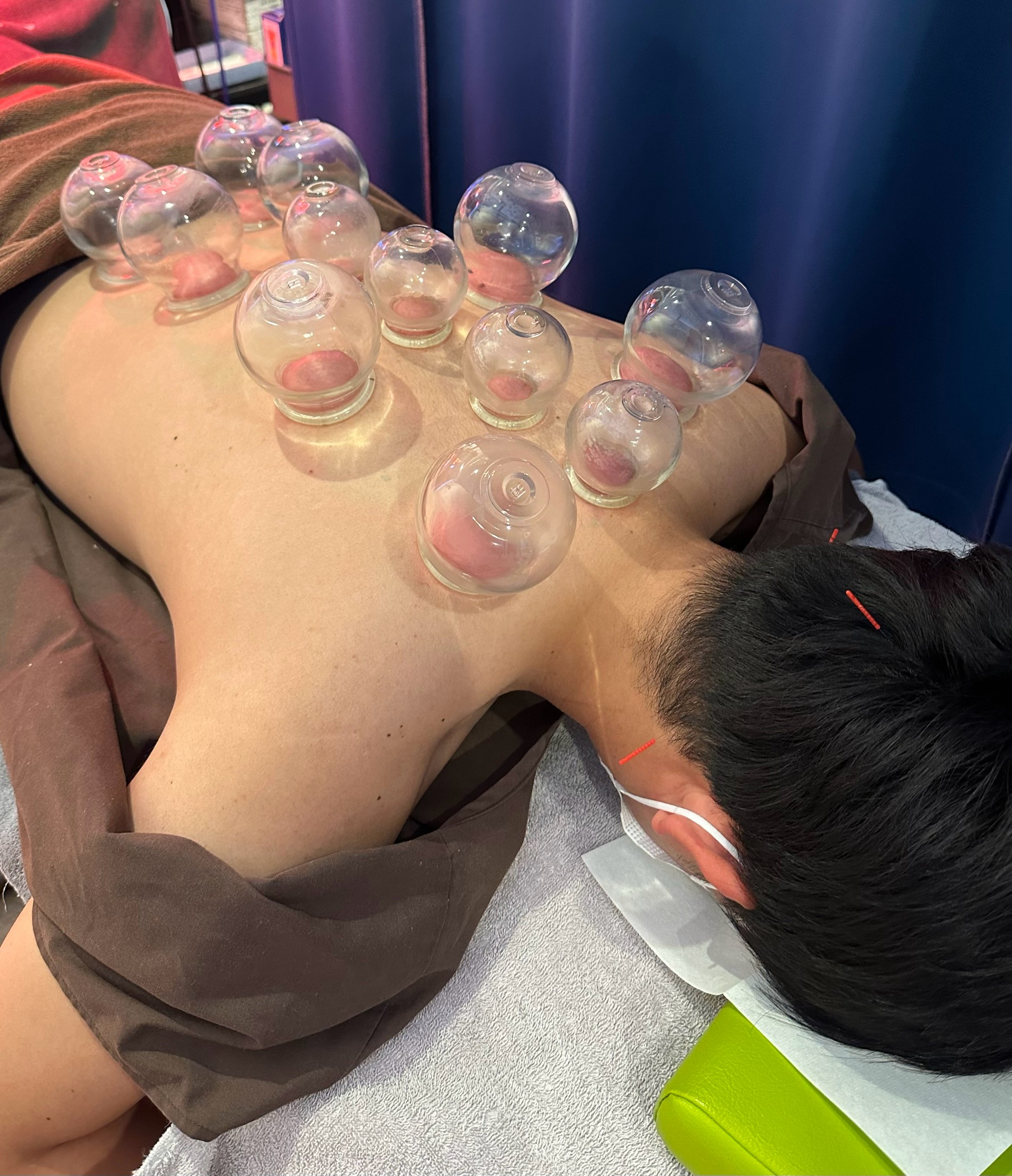 カッピングをして血流を改善