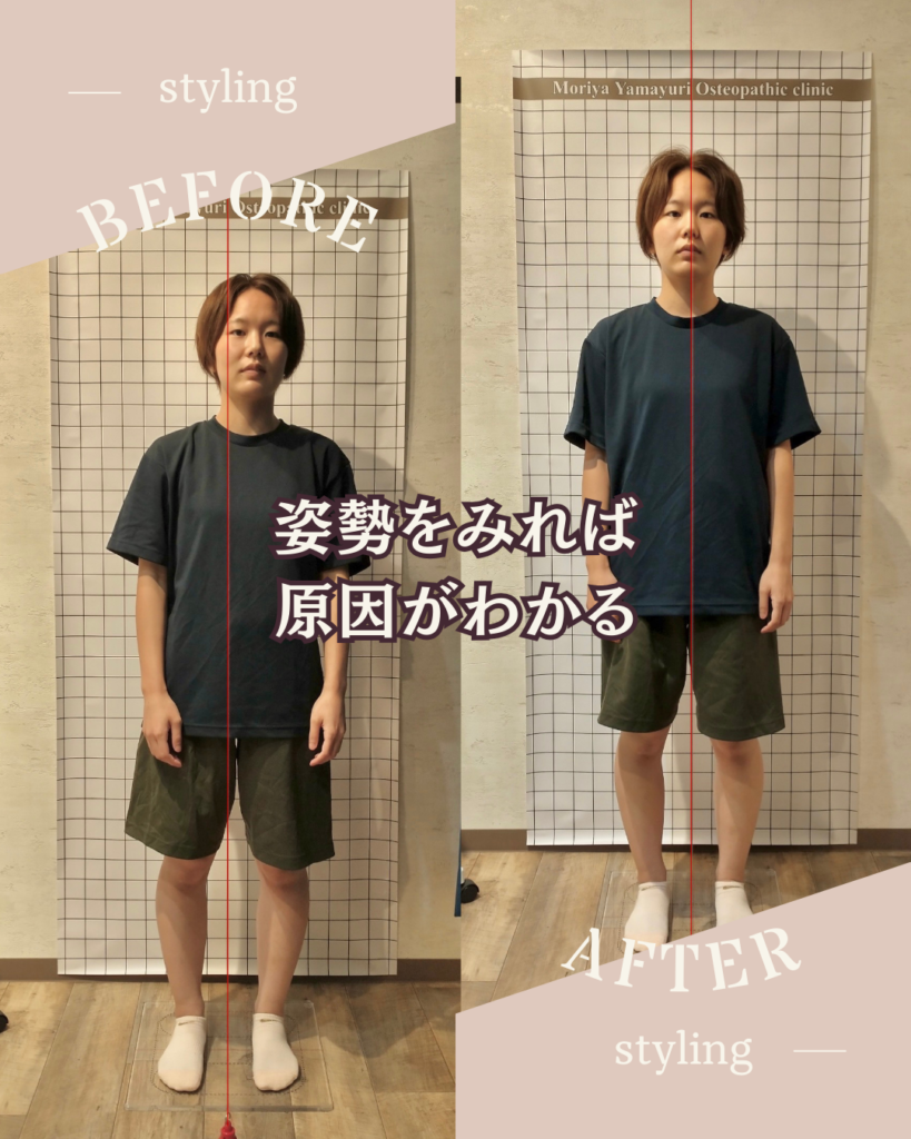 みらい平Lifefun鍼灸接骨院で姿勢分析をしている様子